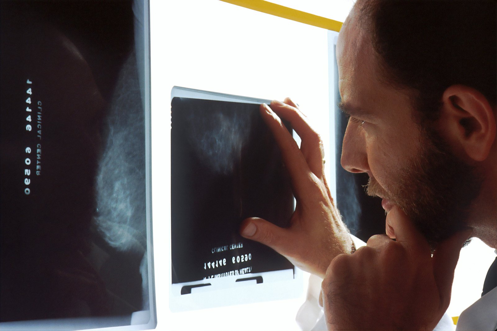 El cáncer de próstata repunta en EE.UU. tras una década a la baja